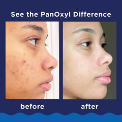 PanOxyl 10% Benzoyl Peroxide Acne Foaming Wash, Maximum Strength, Daily Acne-Fighting Face & Body Cleanser, Face Wash to Clear, Treat and Prevent Acne Pimples and Stubborn Breakouts, 5.5 Oz, Pack of 2